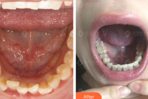 深圳美芮（原雅唯）醫(yī)療美容門診部彭翼整形價(jià)格表附牙齒矯正案例展示