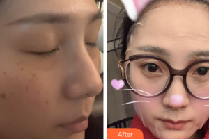 深圳麗港麗格醫(yī)療美容門診部向曉舟整形價(jià)格表附超激光美膚+祛斑針案例展示