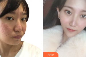 深圳博愛醫(yī)院整形美容中心朱建生整形價(jià)格表附祛痘美白案例展示