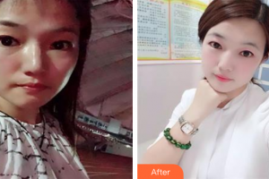 深圳博愛醫(yī)院整形美容中心周春香整形價(jià)格表附光子嫩膚案例展示