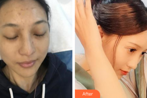 深圳博愛醫(yī)院整形美容中心常振河整形價(jià)格表附光子嫩膚案例展示