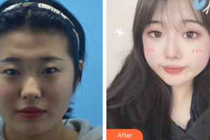 深圳韓美爾醫(yī)療美容門診部賈章明整形價(jià)格表附埋線雙眼皮案例展示