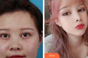 深圳銘醫(yī)醫(yī)療美容醫(yī)院裴南錫整形價(jià)格表附耳軟骨鼻部手術(shù)案例展示