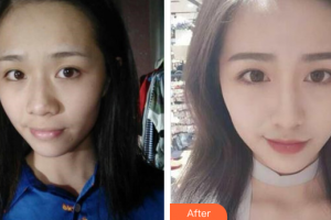 深圳韓美爾醫(yī)療美容門診部高羅鏞整形價(jià)格表附鼻部手術(shù)案例展示