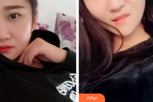 深圳銘醫(yī)醫(yī)療美容醫(yī)院于秀英整形價(jià)格表附根管調(diào)節(jié)案例展示