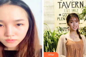 深圳銘醫(yī)醫(yī)療美容醫(yī)院張青松整形價(jià)格表附鼻部手術(shù)案例展示