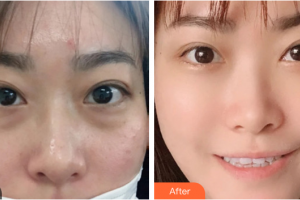 深圳悅己醫(yī)療美容醫(yī)院趙廣慶整形價(jià)格表附去眼袋案例展示