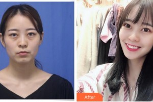 臺州國際眼科醫(yī)院鄭欽象整形價格表附激光去眼袋案例展示