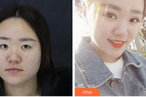 臺州國際眼科醫(yī)院鄧如芝整形價格表附眼部修復(fù)案例展示