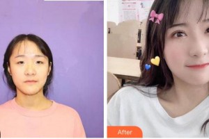 臺州妍度醫(yī)療美容門診部方奎整形價格表附眼部綜合案例展示