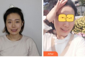 臺州拜博口腔醫(yī)院范沛沛整形價格表附牙齒隱形矯正案例展示