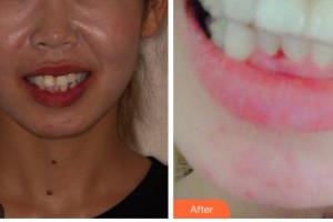 臺州康貝佳口腔醫(yī)院趙潤植整形價格表附牙齒隱形矯正案例展示