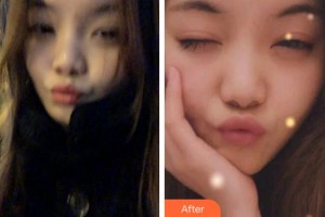 臺州康貝佳口腔醫(yī)院張俊飛整形價格表附牙齒隱形矯正案例展示