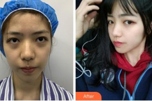 麗水思齊整形外科門診部BrianKinney整形價格表附埋線提升案例展示