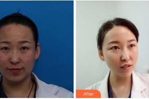 四川西嬋整形美容醫(yī)院蒲興旺整形價(jià)格表附埋線提升案例展示