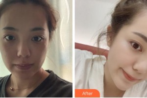 四川西嬋整形美容醫(yī)院楊秀珍整形價(jià)格表附光子嫩膚案例展示