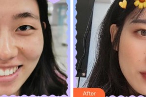 四川西嬋整形美容醫(yī)院肖慶昌整形價(jià)格表附眼部綜合案例展示