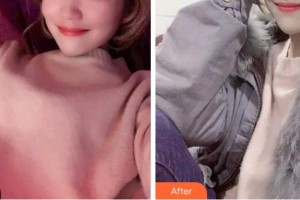 四川西嬋整形美容醫(yī)院孟家麟教授、整形價(jià)格表附超聲波潔牙案例展示