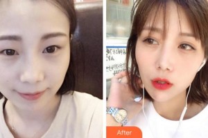 四川西嬋整形美容醫(yī)院王勇丁整形價(jià)格表附眼部綜合案例展示