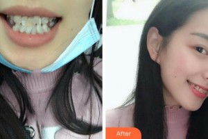 四川西嬋整形美容醫(yī)院石中慧美容口腔科醫(yī)師整形價(jià)格表附牙齒陶瓷矯正案例展示