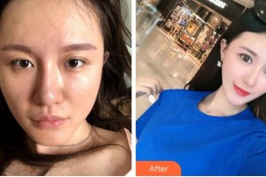 四川西嬋整形美容醫(yī)院劉玉峰教授 美容皮膚顧問整形價(jià)格表附埋線提升案例展示