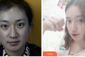 四川西嬋整形美容醫(yī)院李健寧整形價(jià)格表附熱瑪吉案例展示