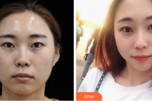 四川西嬋整形美容醫(yī)院胡杰整形價(jià)格表附熱瑪吉案例展示