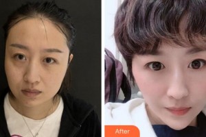 四川華人醫(yī)聯(lián)整形美容醫(yī)院黃偉整形價(jià)格表附埋線提升案例展示