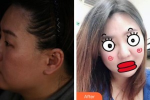 四川華人醫(yī)聯(lián)整形美容醫(yī)院游曉波整形價格表附埋線提升案例展示