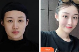 四川省人民醫(yī)院整形外科傅榮整形價格表附埋線提升案例展示