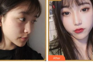 四川省人民醫(yī)院整形外科鐘雷整形價格表附埋線提升案例展示