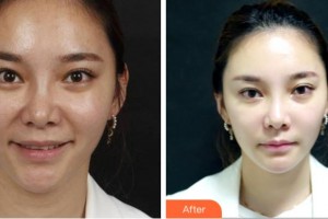 四川武警總隊醫(yī)院樂山分院燒傷整形科余順先整形價格表附熱瑪吉案例展示