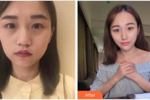 四川武警總隊(duì)醫(yī)院樂山分院燒傷整形科袁文周整形價(jià)格表附熱瑪吉案例展示