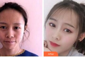 四川美萊醫(yī)學(xué)美容醫(yī)院韓國棟整形價(jià)格表附埋線提升案例展示