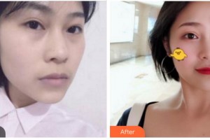 四川武警總隊(duì)醫(yī)院樂山分院燒傷整形科帥秀蓉整形價(jià)格表附埋線提升案例展示