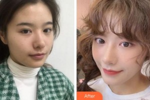 四川大學(xué)華西口腔醫(yī)院美容中心余自能整形價格表附熱瑪吉案例展示