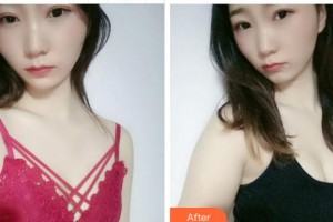 四川西嬋整形美容醫(yī)院謝凱英整形價(jià)格表附自體脂肪隆胸案例展示