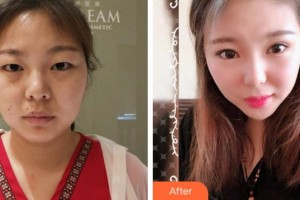 四川西嬋整形美容醫(yī)院樊明山整形價格表附激光祛斑案例展示