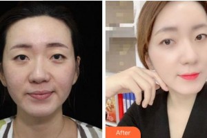 四川華人醫(yī)聯(lián)整形美容醫(yī)院王革整形價格表附熱拉提案例展示