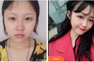 四川華人醫(yī)聯(lián)整形美容醫(yī)院郭景璽整形價(jià)格表附埋線提升案例展示