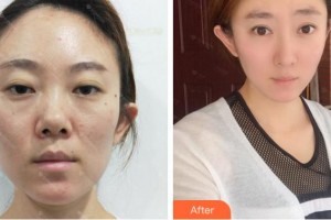 四川華人醫(yī)聯(lián)整形美容醫(yī)院劉全整形價(jià)格表附鼻部綜合案例展示