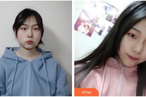 四川華美紫馨醫(yī)學(xué)美容醫(yī)院黃劍美整形價格表附埋線提升案例展示