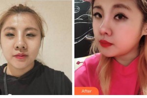 四川華美紫馨醫(yī)學(xué)美容醫(yī)院李純青整形價(jià)格表附熱瑪吉案例展示