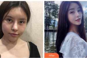 四川華美紫馨醫(yī)學(xué)美容醫(yī)院秦曉整形價(jià)格表附熱瑪吉案例展示