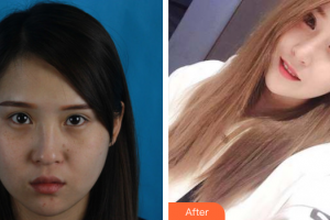 深圳悅己醫(yī)療美容醫(yī)院張珉整形價(jià)格表附耳軟骨復(fù)合隆鼻案例展示