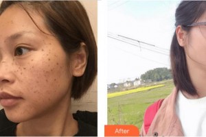 四川西嬋整形美容醫(yī)院顏磊整形價格表附祛斑案例展示