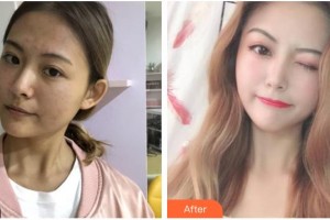 四川華美紫馨醫(yī)學(xué)美容醫(yī)院黃文整形價(jià)格表附皮膚管理案例展示