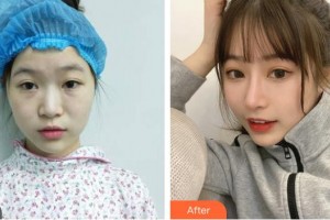 四川軍大醫(yī)學(xué)研究所附屬醫(yī)院美容整形科蒲小兵整形價(jià)格表附膨體隆鼻案例展示