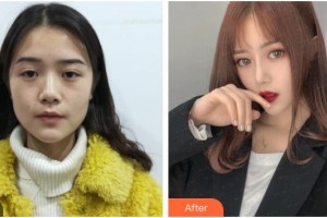 四川西嬋泛亞醫(yī)學美容醫(yī)院孔正植整形價格表附膨體隆鼻案例展示