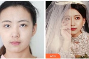 四川西嬋泛亞醫(yī)學美容醫(yī)院廖茄利整形價格表附熱瑪吉案例展示